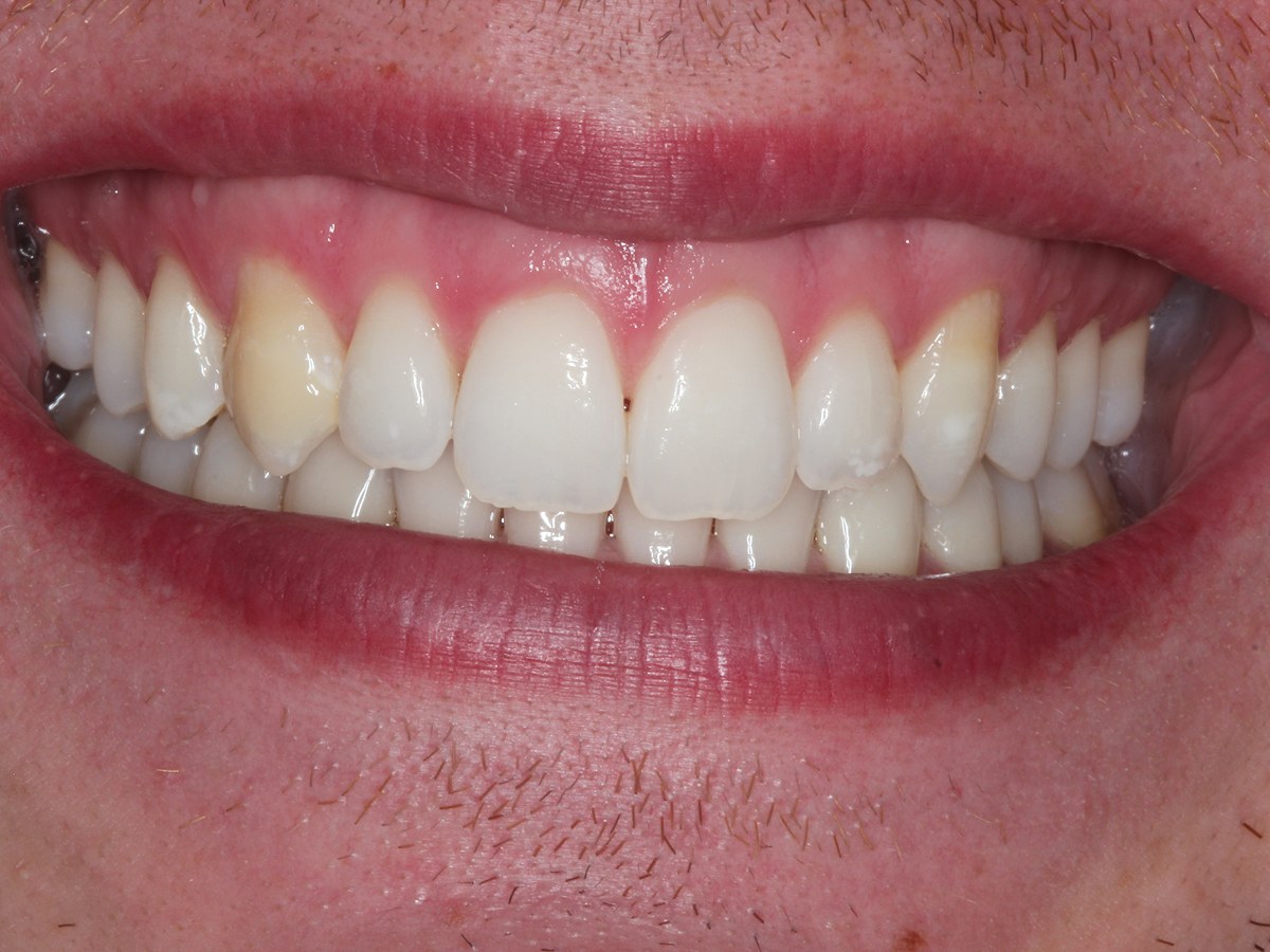 After: Before and after composite bonding: discoloured, crowded-looking teeth brightened and balanced