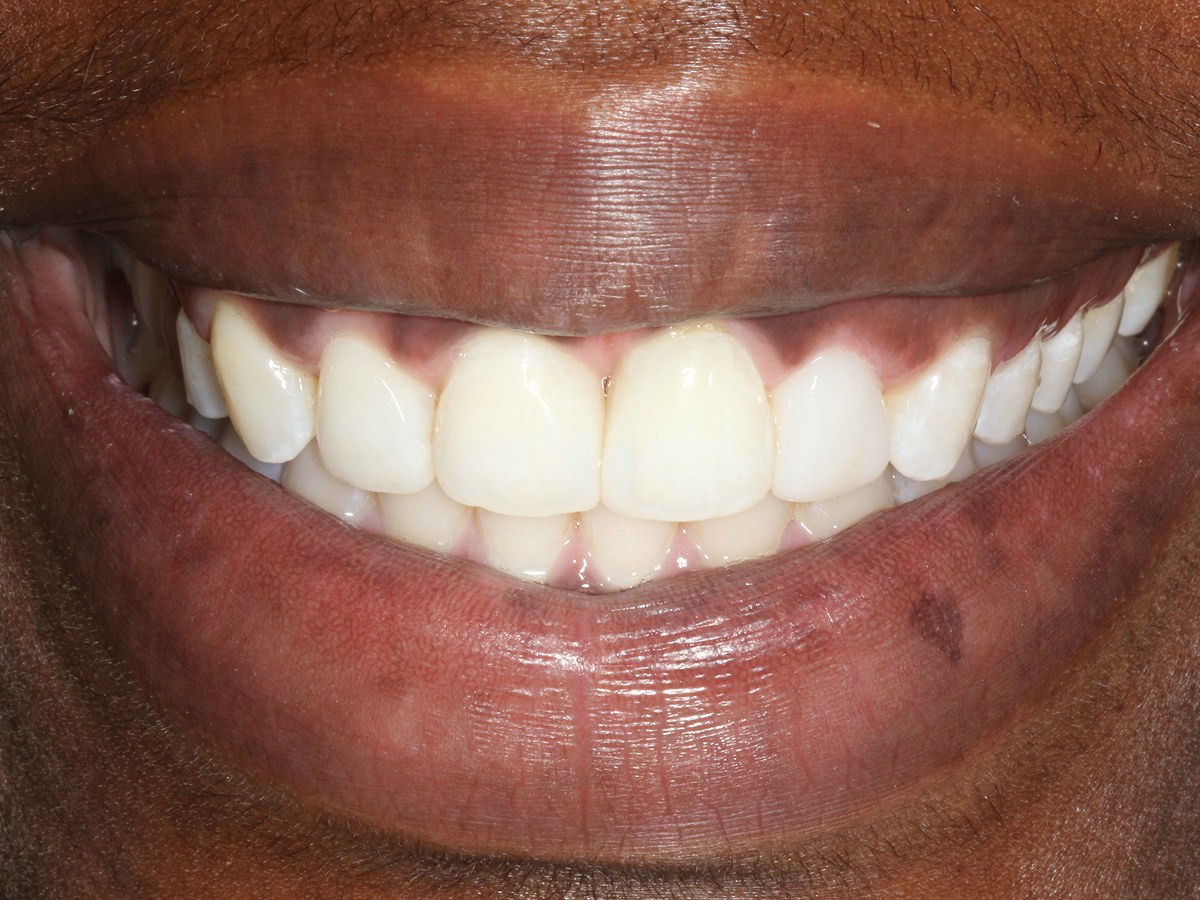 After: Before and after composite bonding: midline gap and uneven upper front teeth reshaped into a straight, even smile