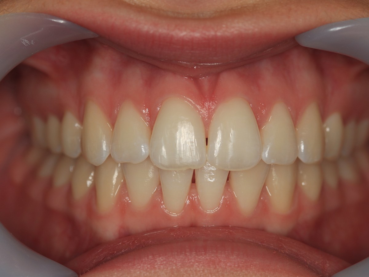 After: Before and after composite bonding: worn, uneven upper front teeth reshaped for an even smile line