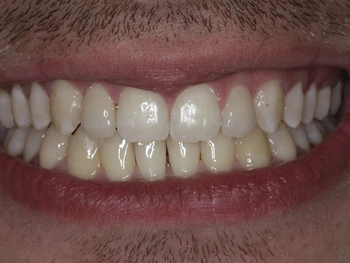 After: Before and after composite bonding: gap between the upper front teeth closed