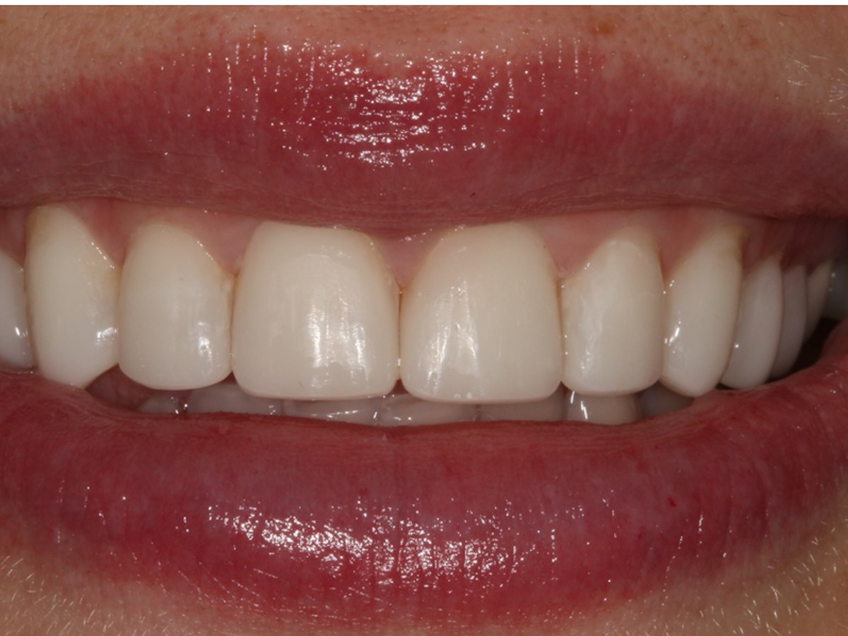 After: Before and after composite bonding: short, worn front teeth lengthened and evened out