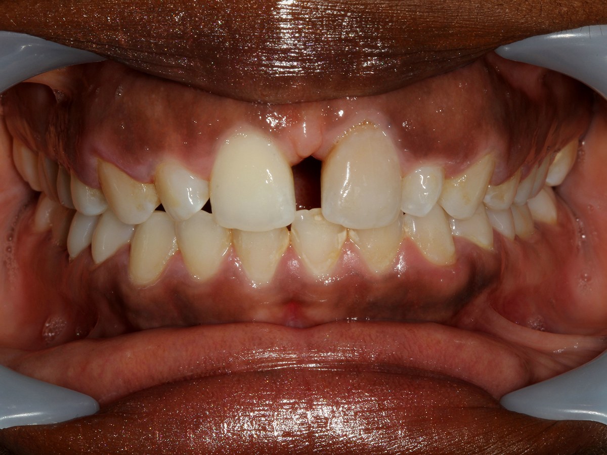 Before: Before and after composite bonding: midline gap and uneven upper front teeth reshaped into a straight, even smile