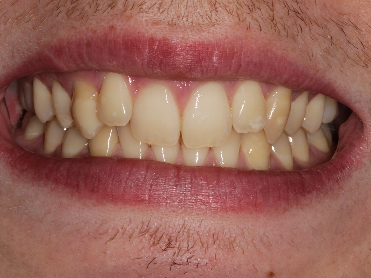 Before: Before and after composite bonding: discoloured, crowded-looking teeth brightened and balanced