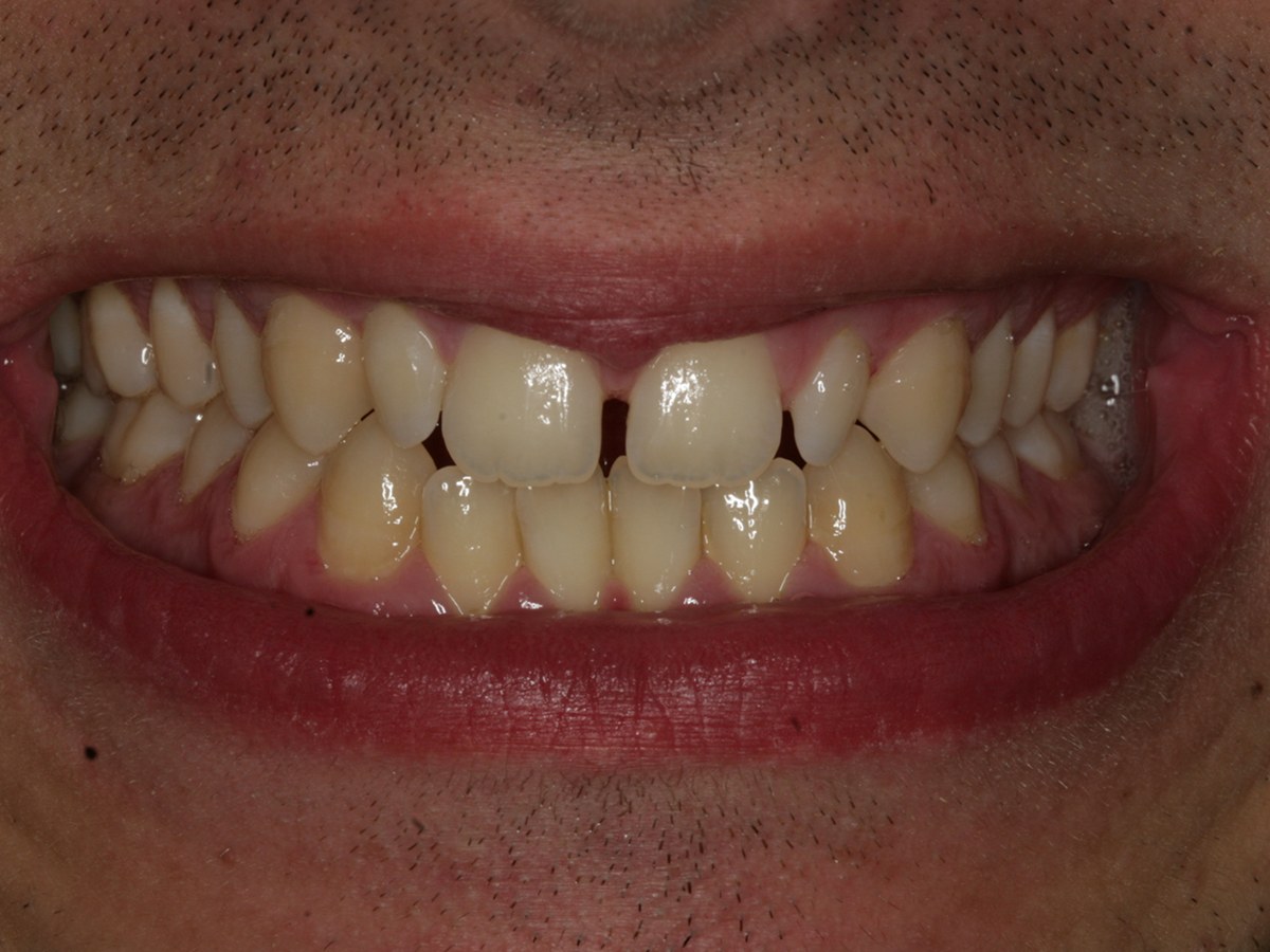 Before: Before and after composite bonding: gap between the upper front teeth closed