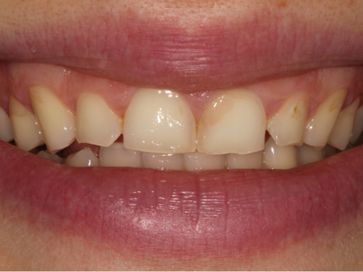 Before: Before and after composite bonding: short, worn front teeth lengthened and evened out