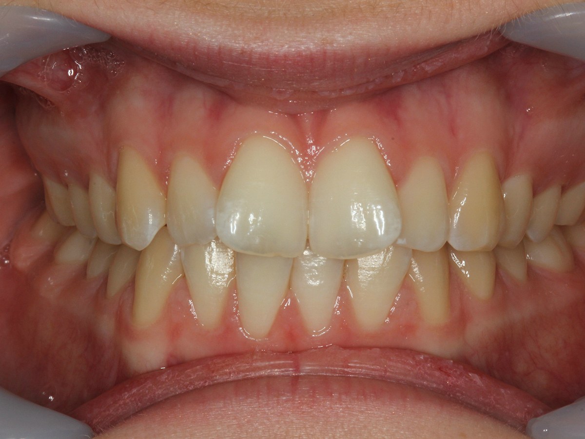 Before: Before and after composite bonding: worn, uneven upper front teeth reshaped for an even smile line