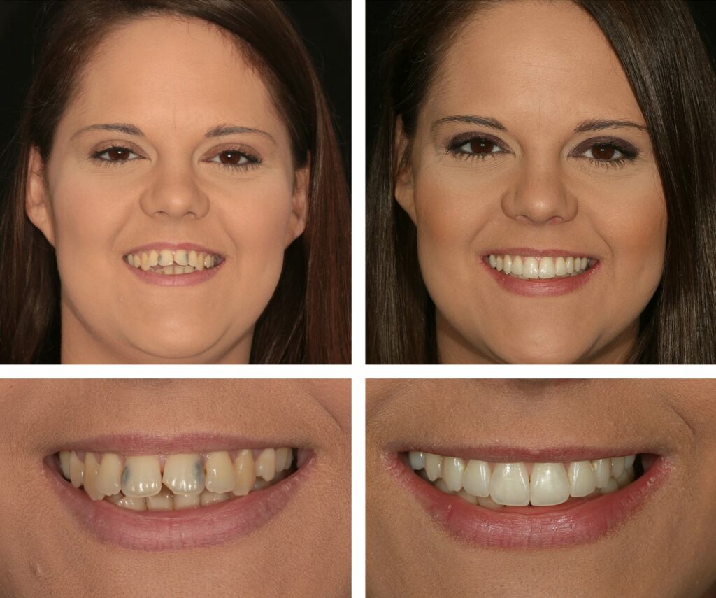 Composite bonding before and after